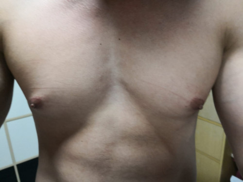 Droopy Nipple Steroid 💉💪Induced Gynecomastia Gland Removal By Dr