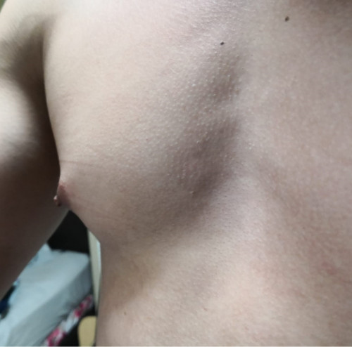 Gynecomastia surgery, the cure for man boobs!