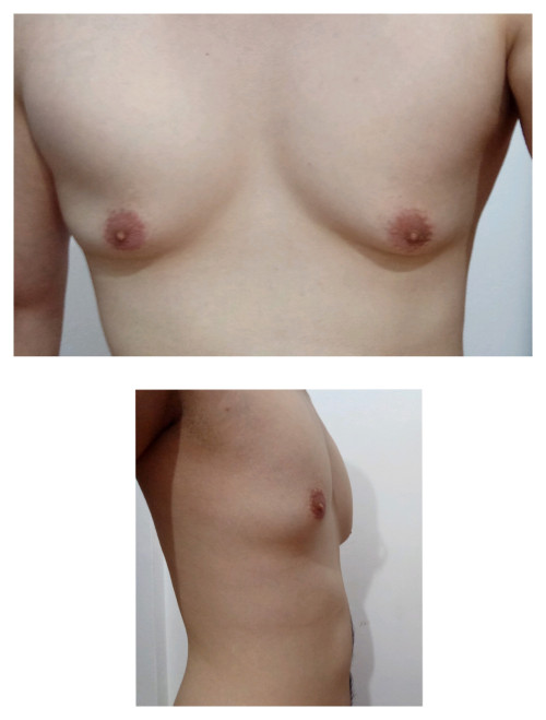 Gynecomastia surgery, the cure for man boobs!