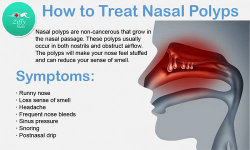 Nasal polyps Blog e1593440975441 - Pictr.com