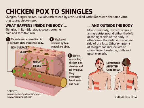 635740571368953153 DFP Shingles DIAGRAM PRESTO