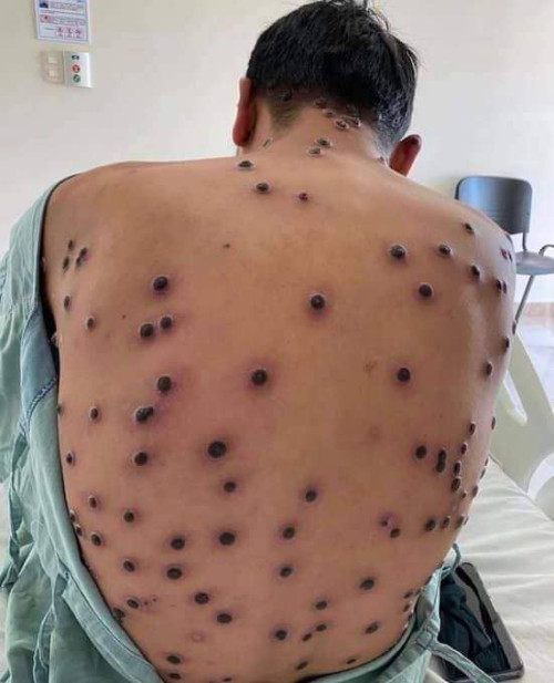 mpox4
