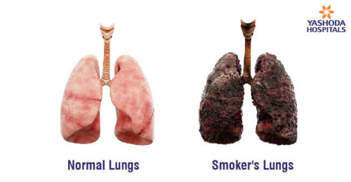 Smoking on Lung Health3