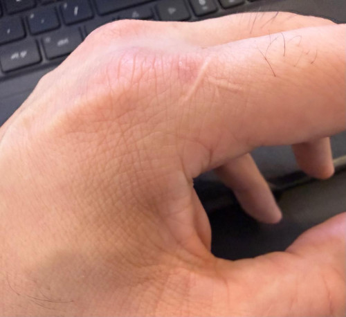 X on Left Index Finger